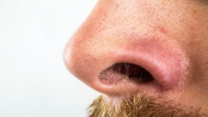 ¿Cómo limpiarse la nariz sin provocar vergüenza?